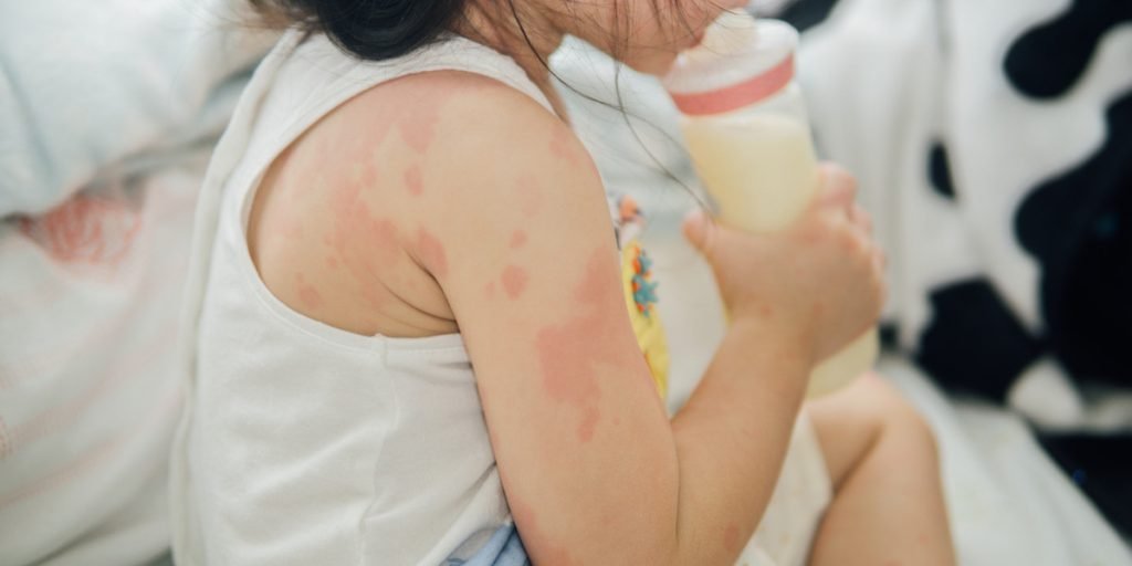 ciri-ciri bayi alergi susu sapi