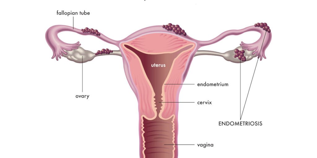 kista endometriosis