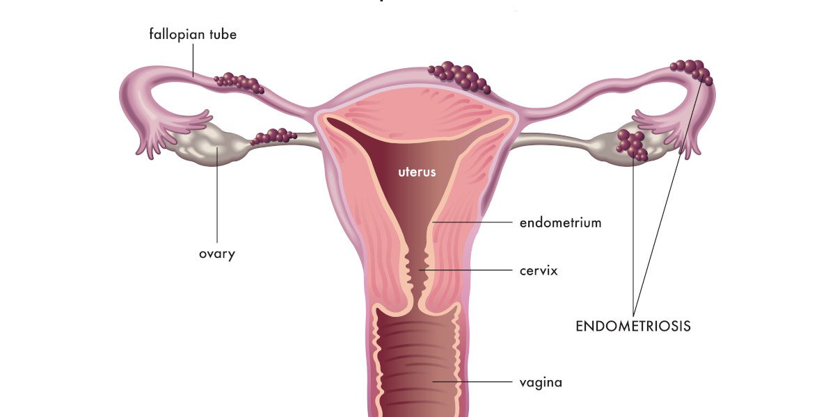 kista endometriosis
