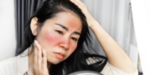 apa itu sunburn