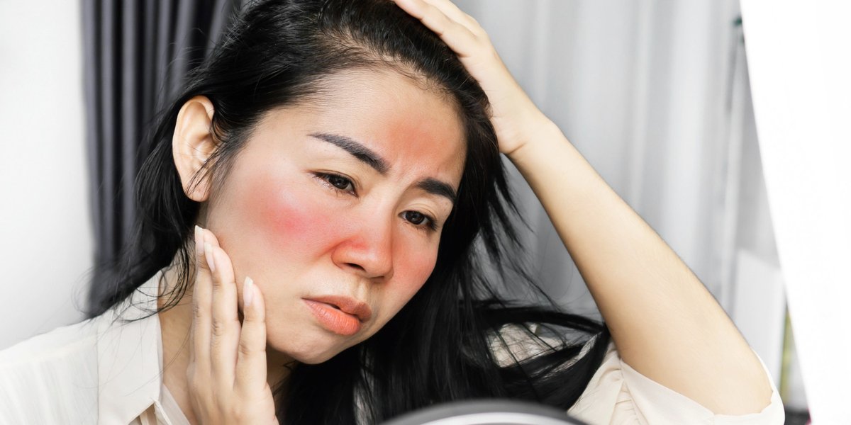apa itu sunburn