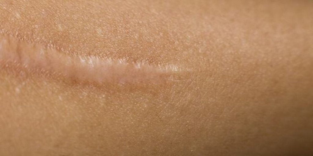 Cara Menghilangkan Keloid yang Aman