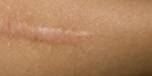 Cara Menghilangkan Keloid yang Aman