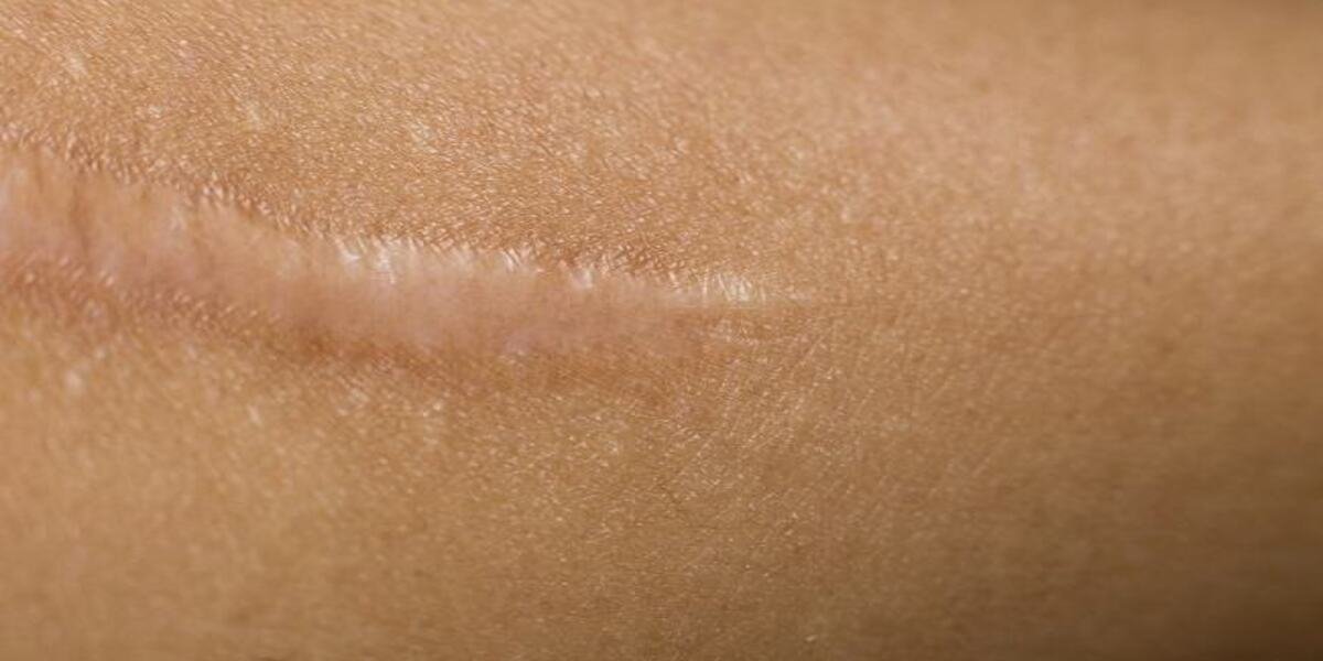 Cara Menghilangkan Keloid yang Aman