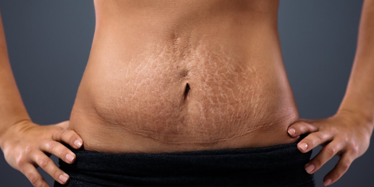 Cara Menghilangkan Stretch Mark