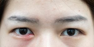 cara mengobati mata bintitan