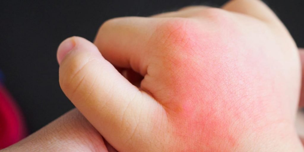 bayi alergi sabun bayi