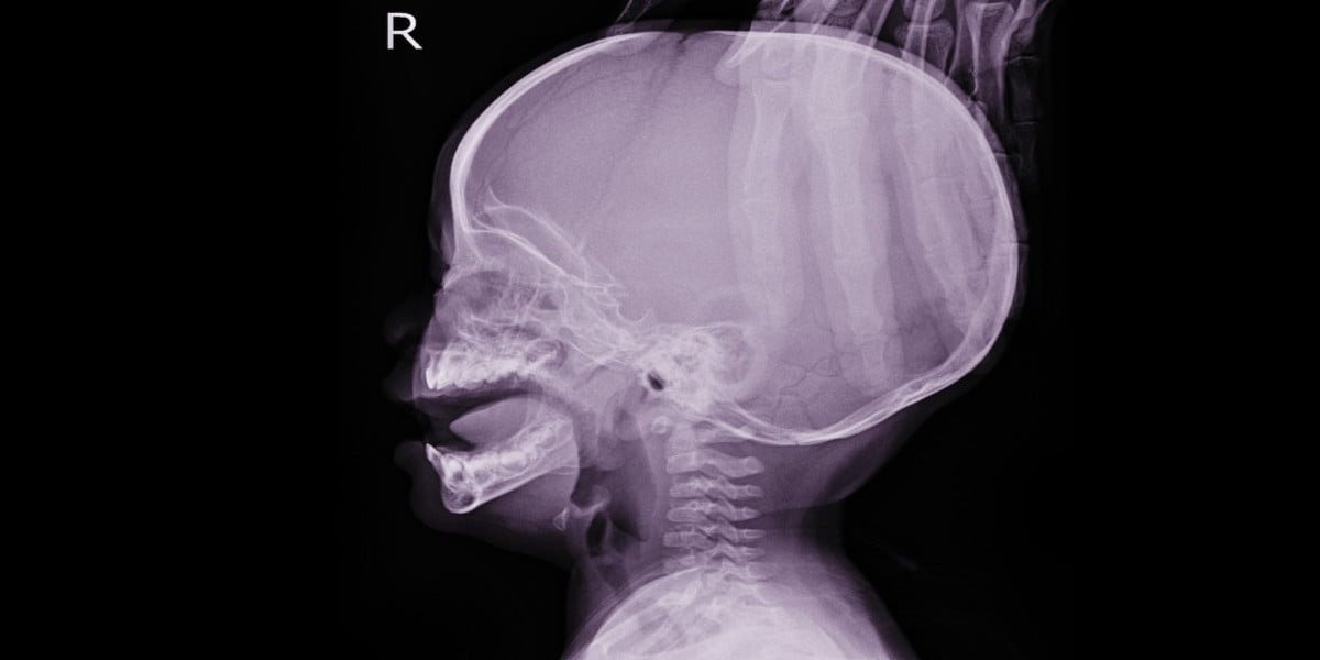 penyakit hidrosefafalus