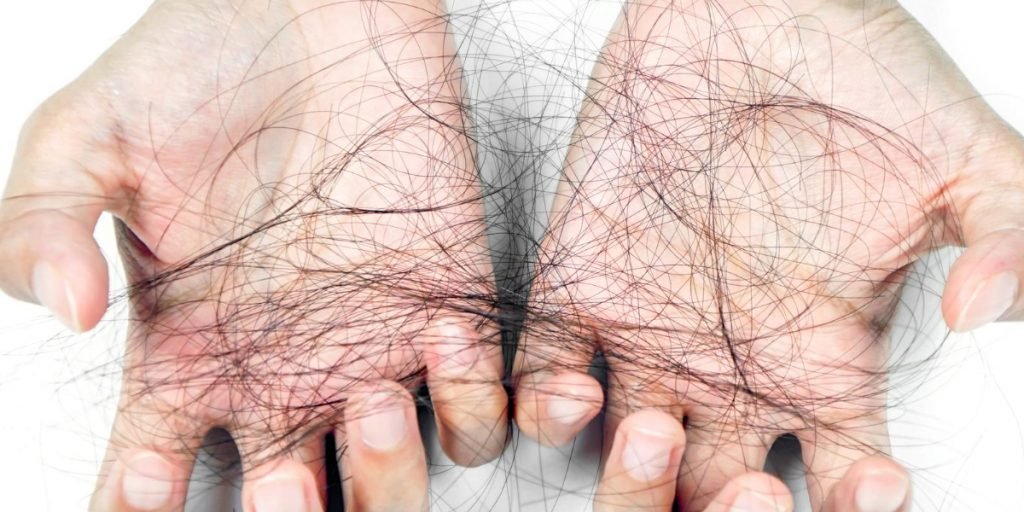 Penjelasan Alopecia Areata