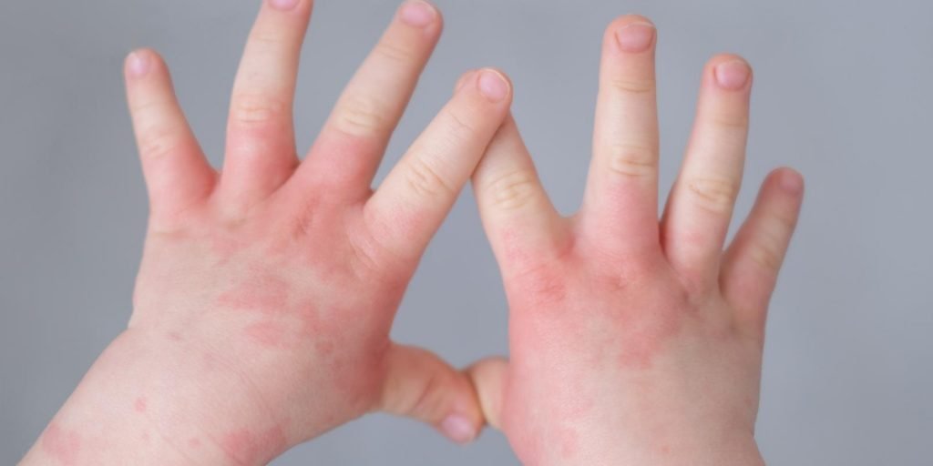 impetigo pada anak