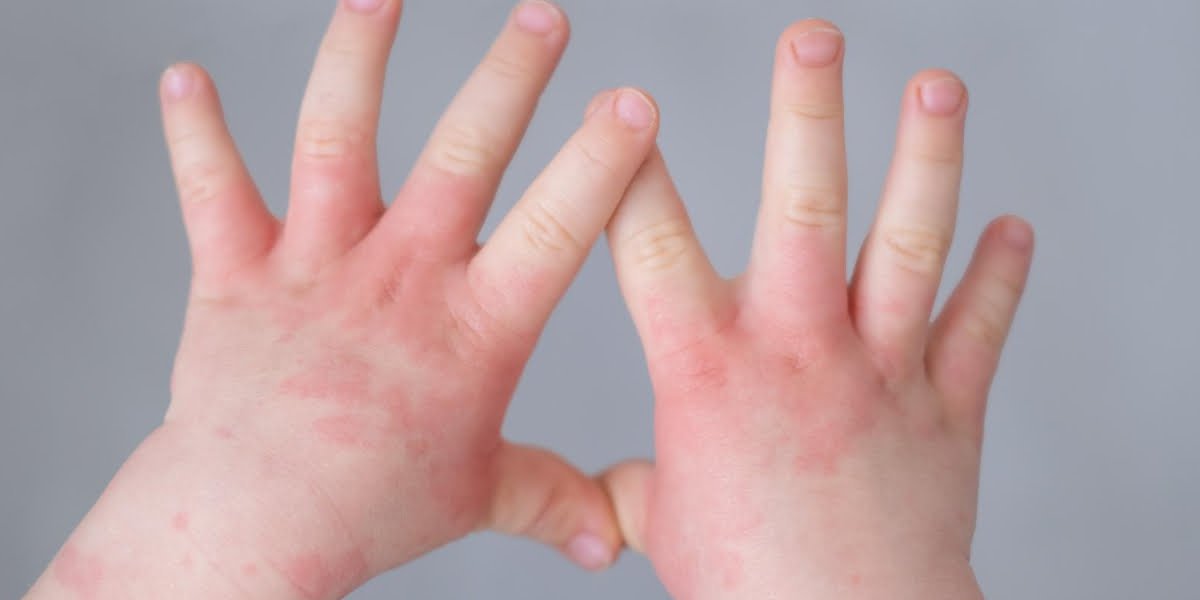 impetigo pada anak