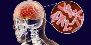penyebab meningitis
