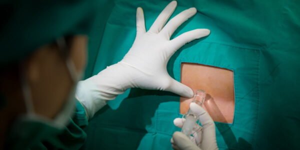 suntik epidural