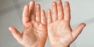hand foot and mouth disease