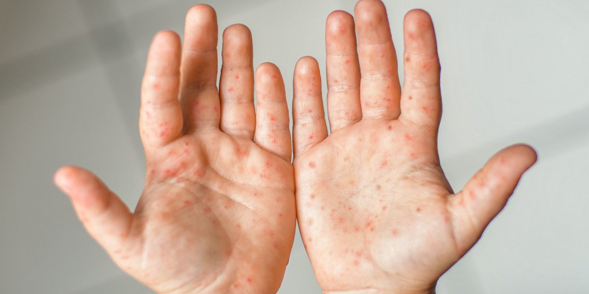 hand foot and mouth disease