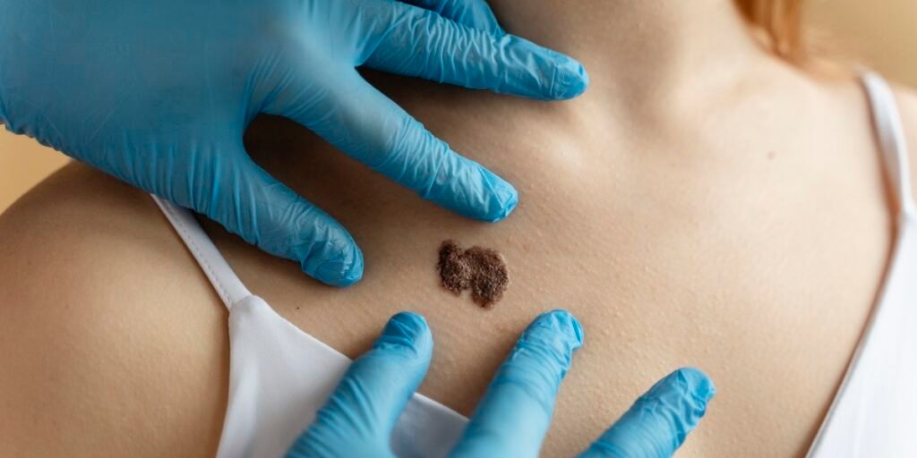 kanker kulit melanoma