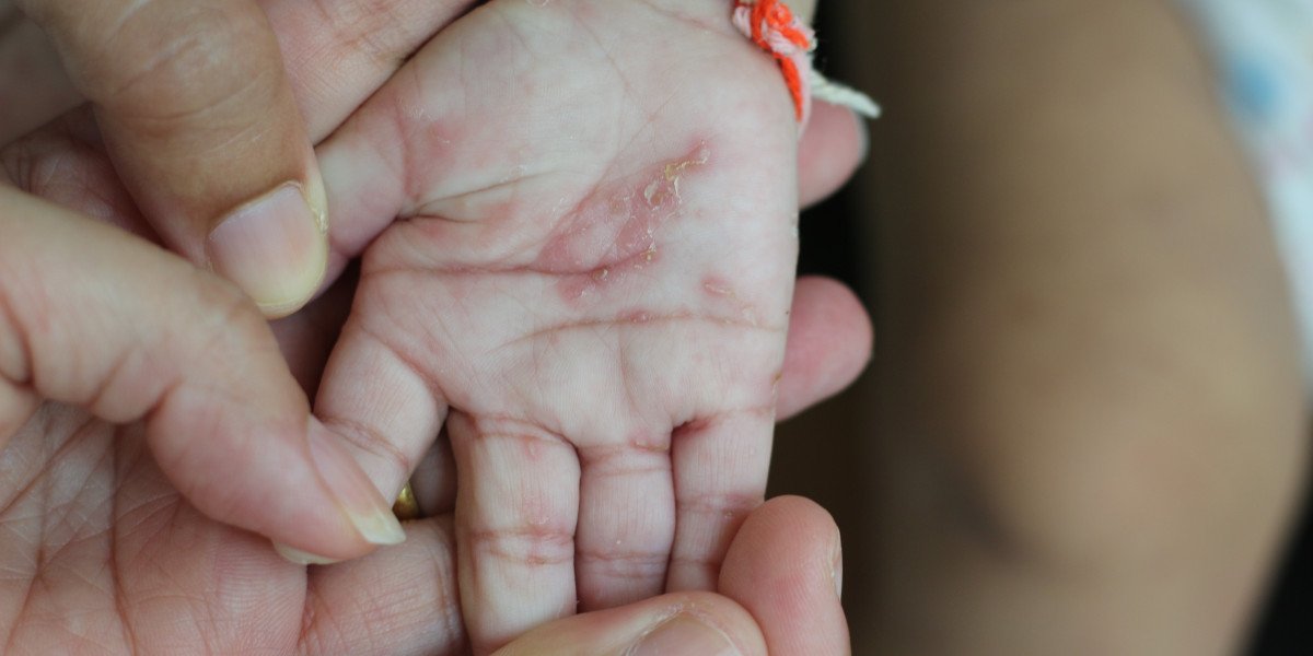 scabies pada anak