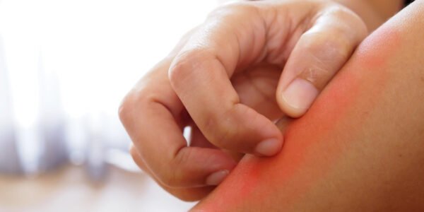 Cara mengatasi gatal akibat infeksi jamur kulit