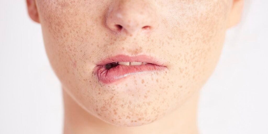 cara menghilangkan freckles