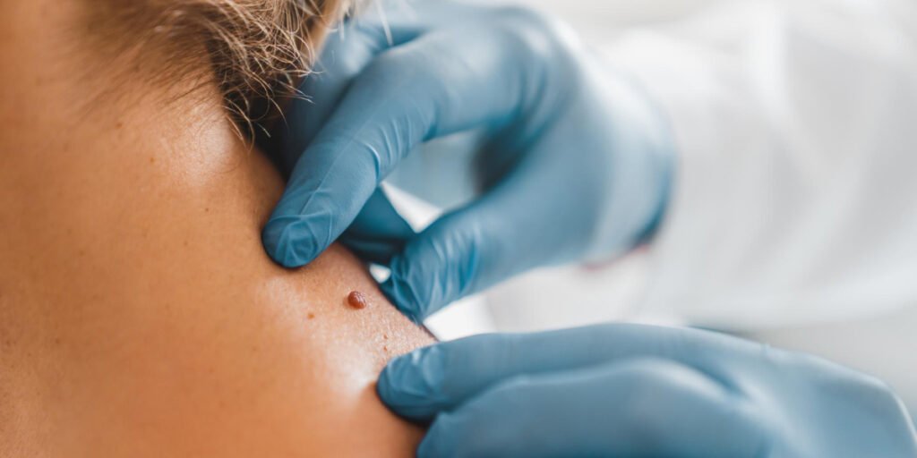 cara menghilangkan skin tag