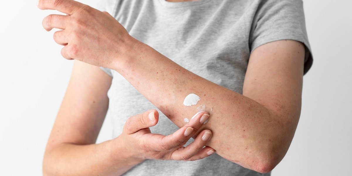 dermatitis atopik adalah