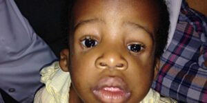Treacher Collins syndrome