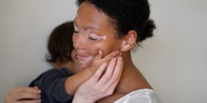 vitiligo adalah