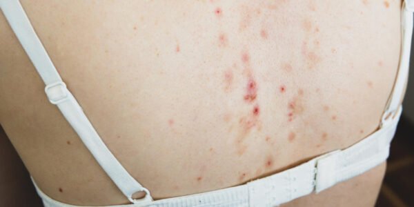 cara menghilangkan jerawat di badan