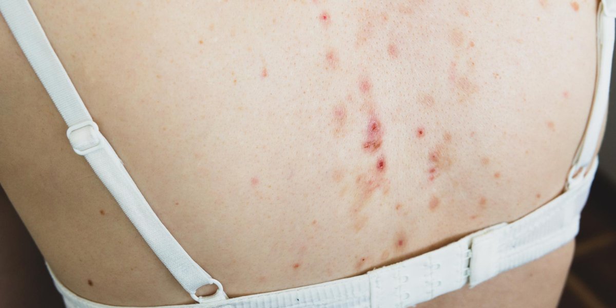 cara menghilangkan jerawat di badan