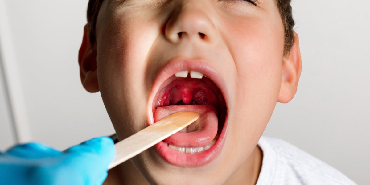 radang tonsil