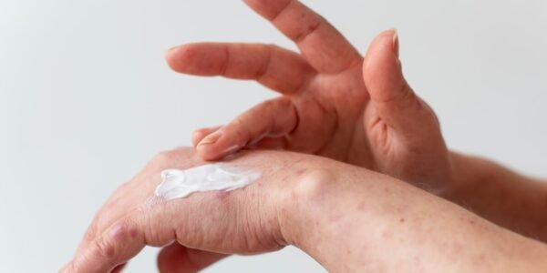 kloderma obat apa