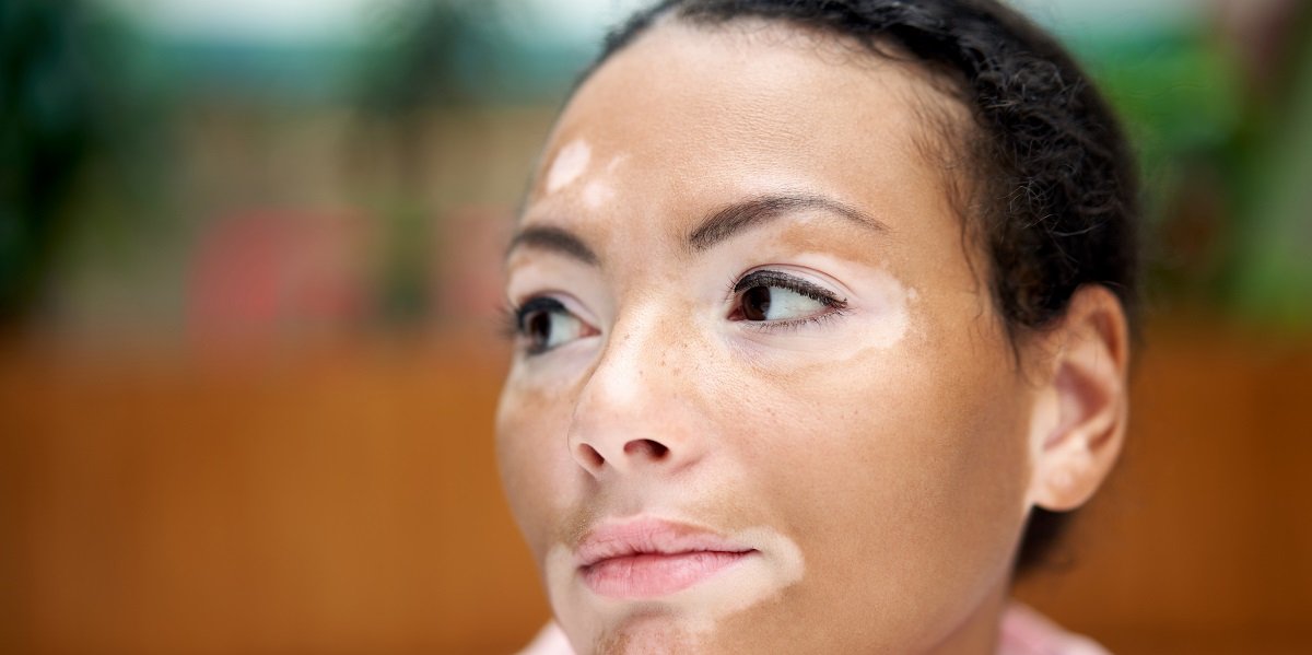 penyakit vitiligo bisa sembuh